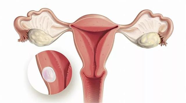 卵巢囊肿的诊断与治疗