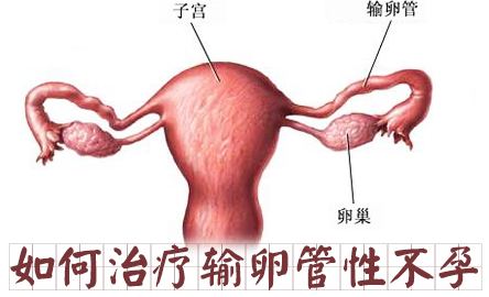 输卵管性不孕